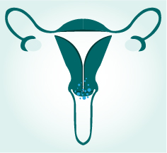 About cervical cancer