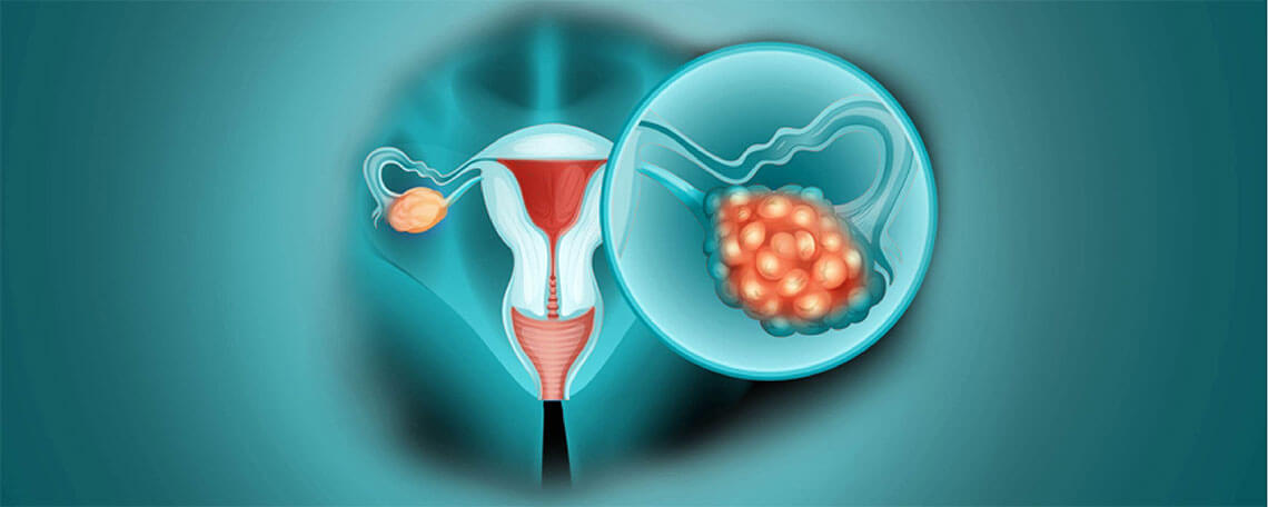 Ovarian Cancer Origin And Causes