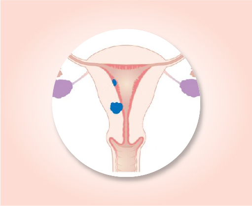 About uterine cancer