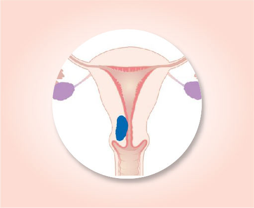 About uterine cancer