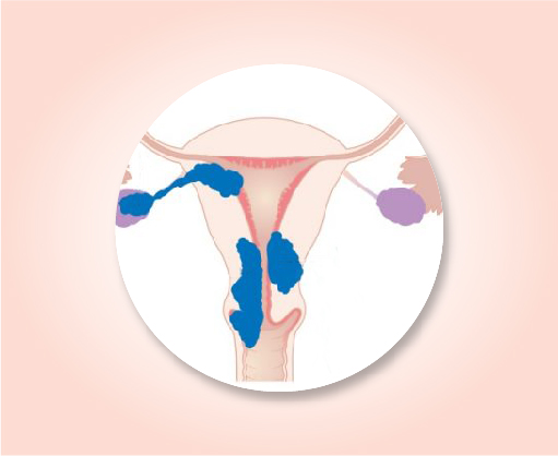 About uterine cancer